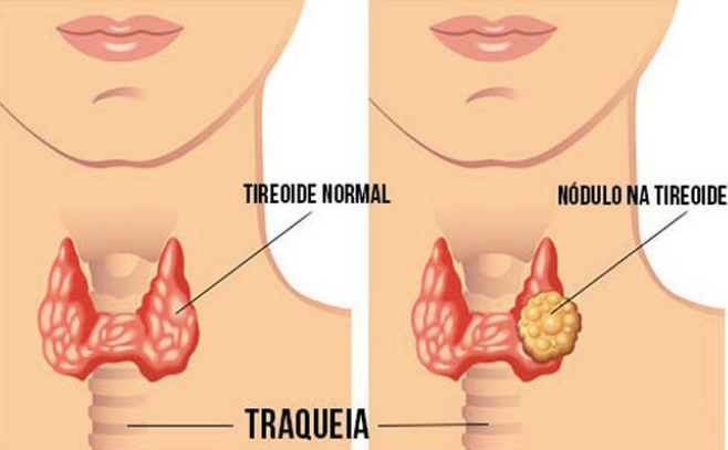 tireoide veja importancia