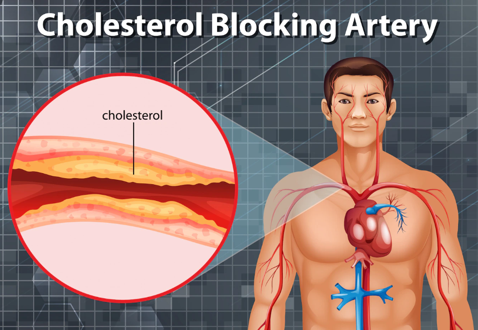 colesterol alto entenda os riscos